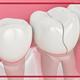چگونه یک دندان ترک خورده را درمان کنیم؟